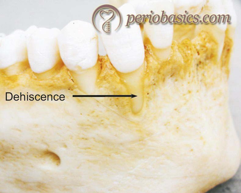 Image showing dehiscence