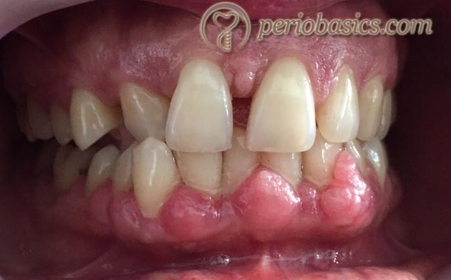 Amlodipine induced gingival enlargement