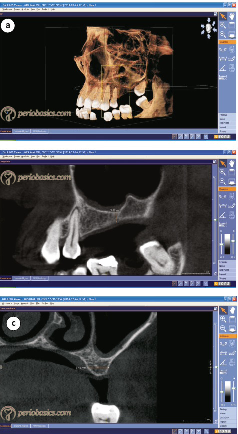 CBCT image of the maxilla where implants have been planned