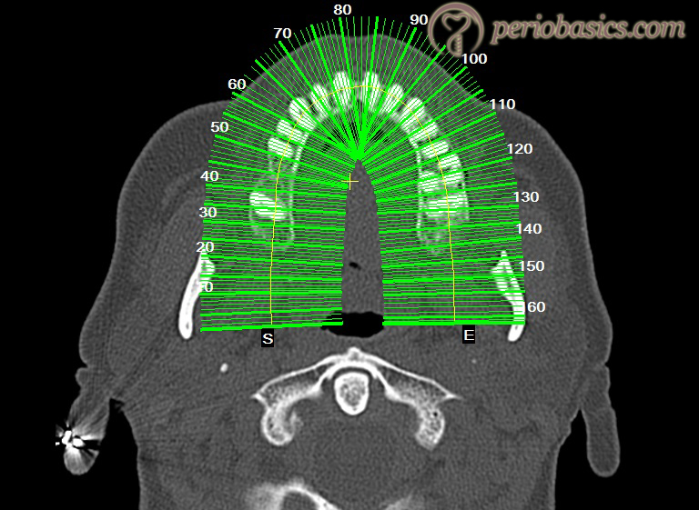 CT-scan showing slices