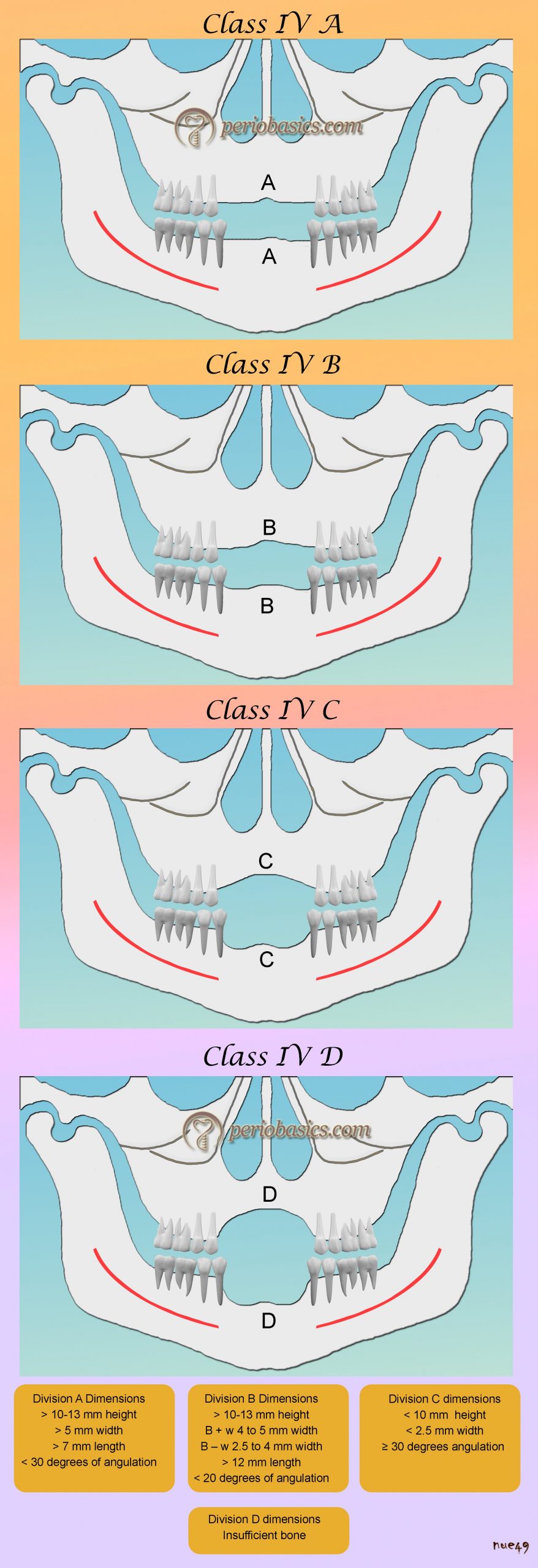 Misch and Judy classification (Class IV situation)