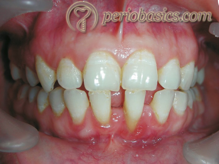 subgingival calculus