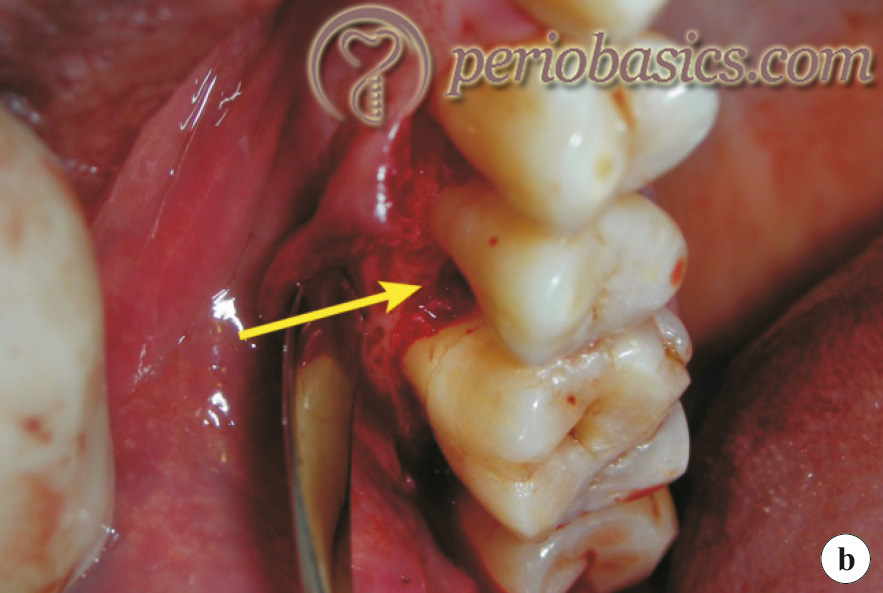 Clinical photographs demonstrating interdental craters between 2nd premolar and 1st molar