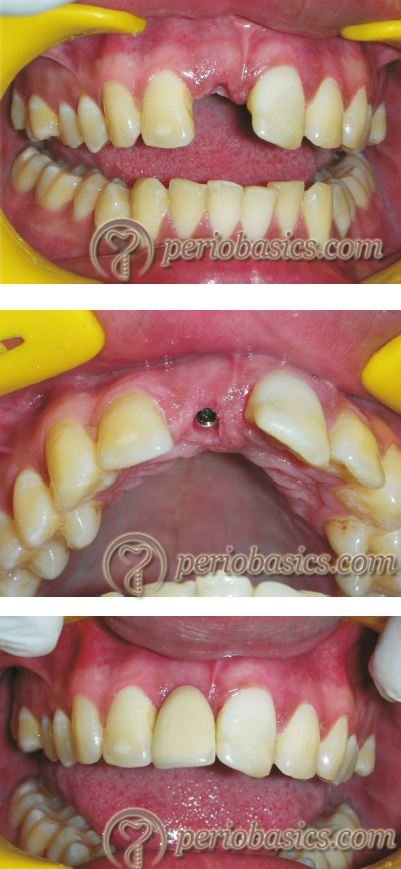 Clinical photographs of a patient demonstrating the placement of implants in esthetic region