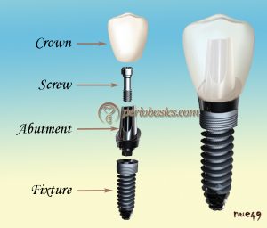 Dental implant components and current concepts in implant design ...
