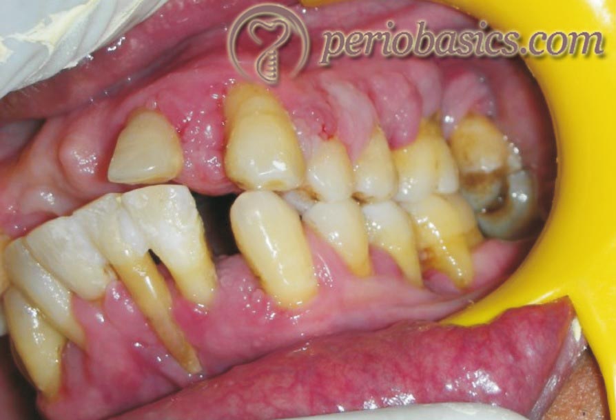 Cyclosporine induced gingival enlargement