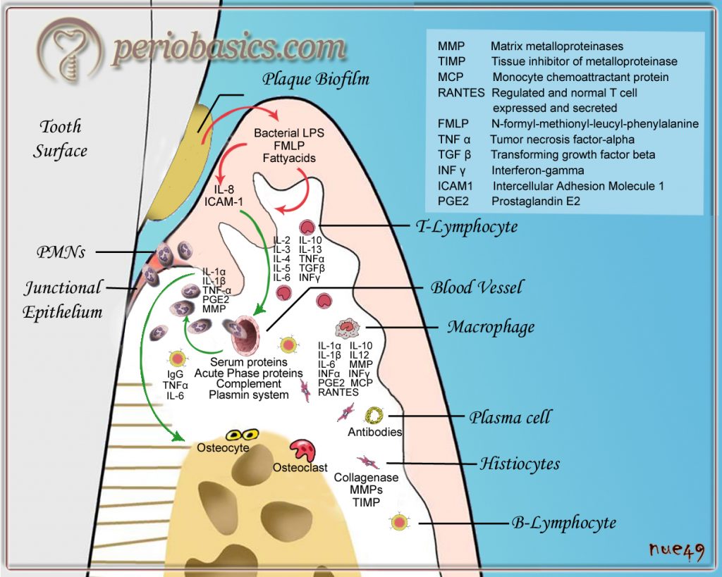 Gingivitis and its clinical features; periobasics.com