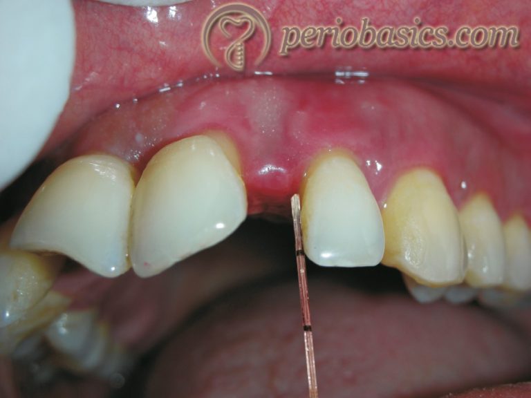 Gingival Crevicular Fluid And Saliva In Periodontal Health And Disease