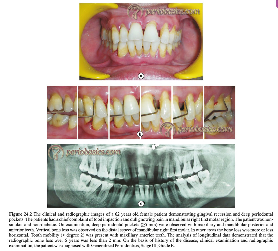 Generalized periodontitis Stage III Grade B