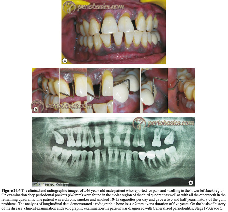 Generalized periodontitis Stage IV Grade C