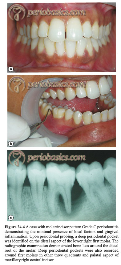 Grade C Periodontitis with molar incisor pattern