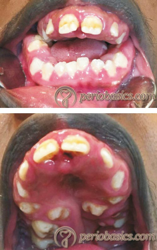 Idiopathic gingival enlargement