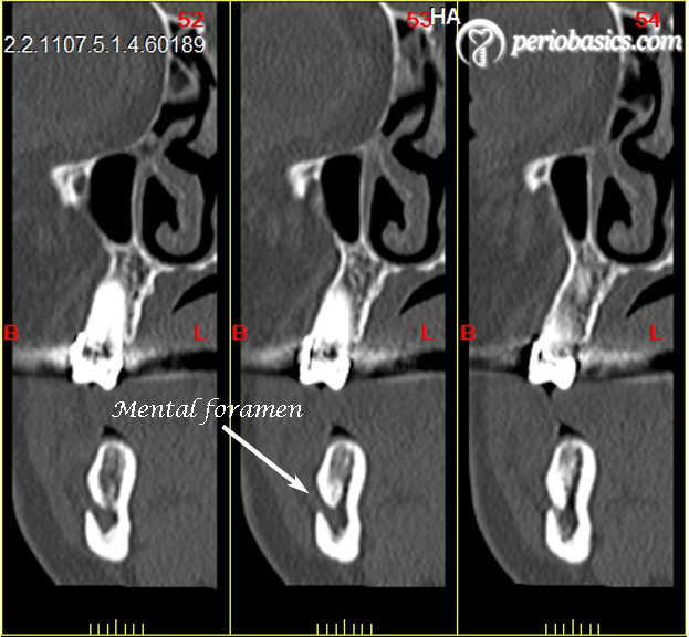 Mental nerve CT scan