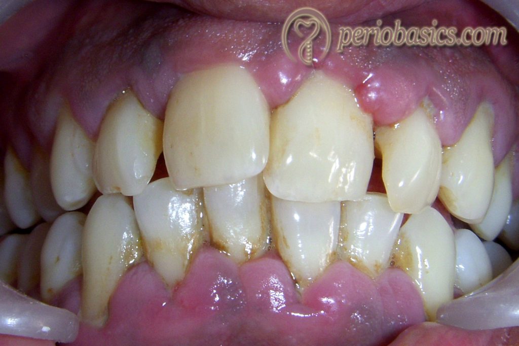 Nifedipine induced gingival enlargement