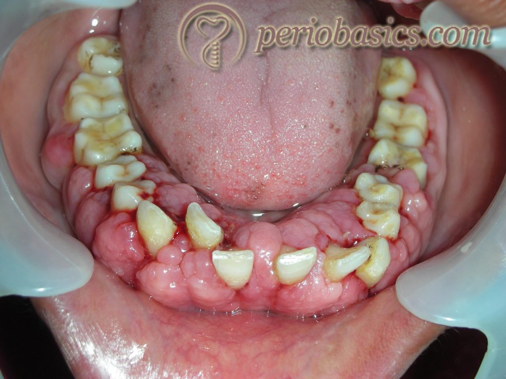 Phenytoin induced gingival enlargement 1