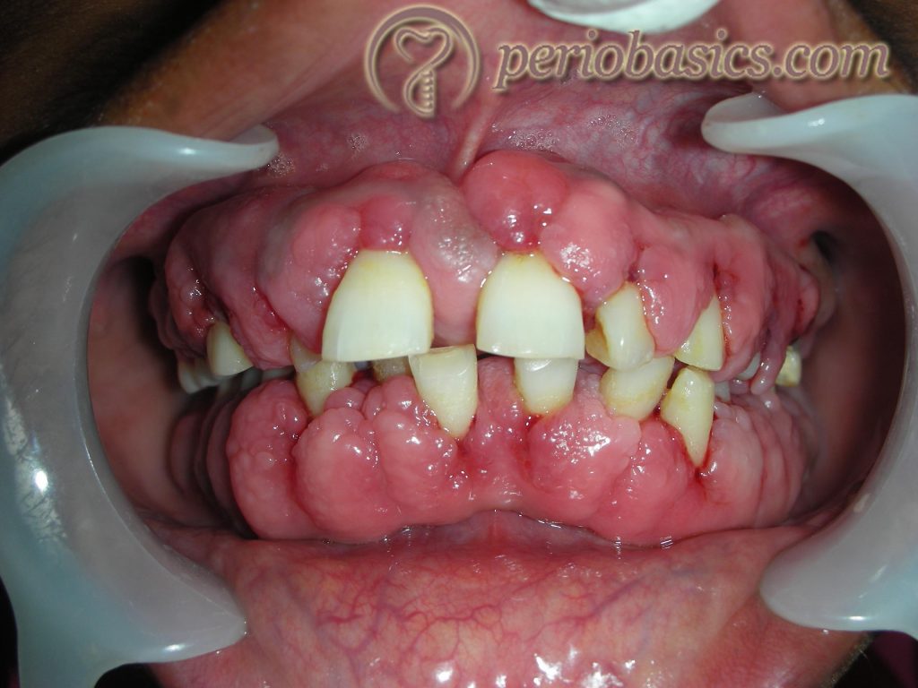 Phenytoin induced gingival enlargement
