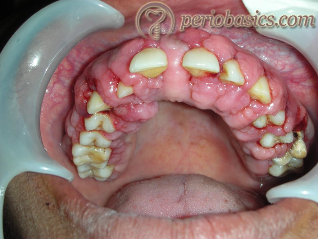 Phenytoin induced gingival enlargement 2