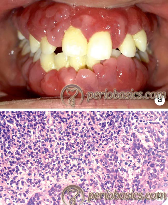 Plasma cell gingivitis