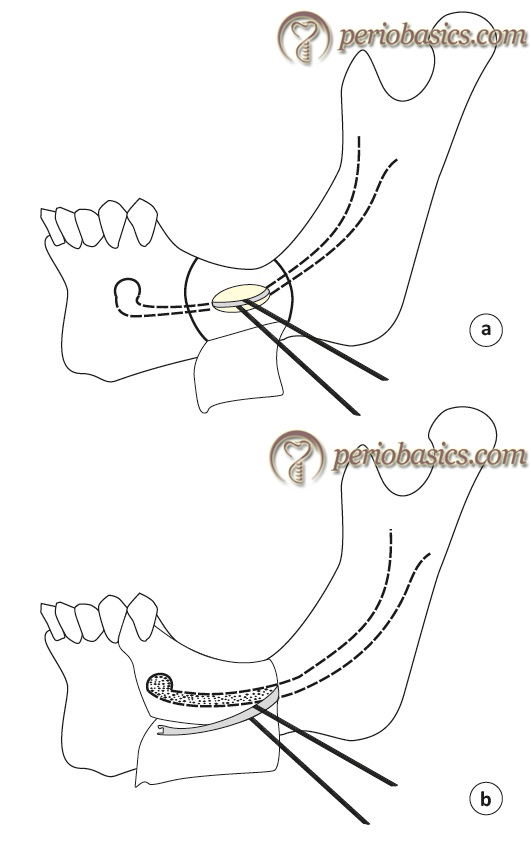 The mandibular nerve lateralization by (a) laterlaliza-tion technique and (b) fenestration technique.
