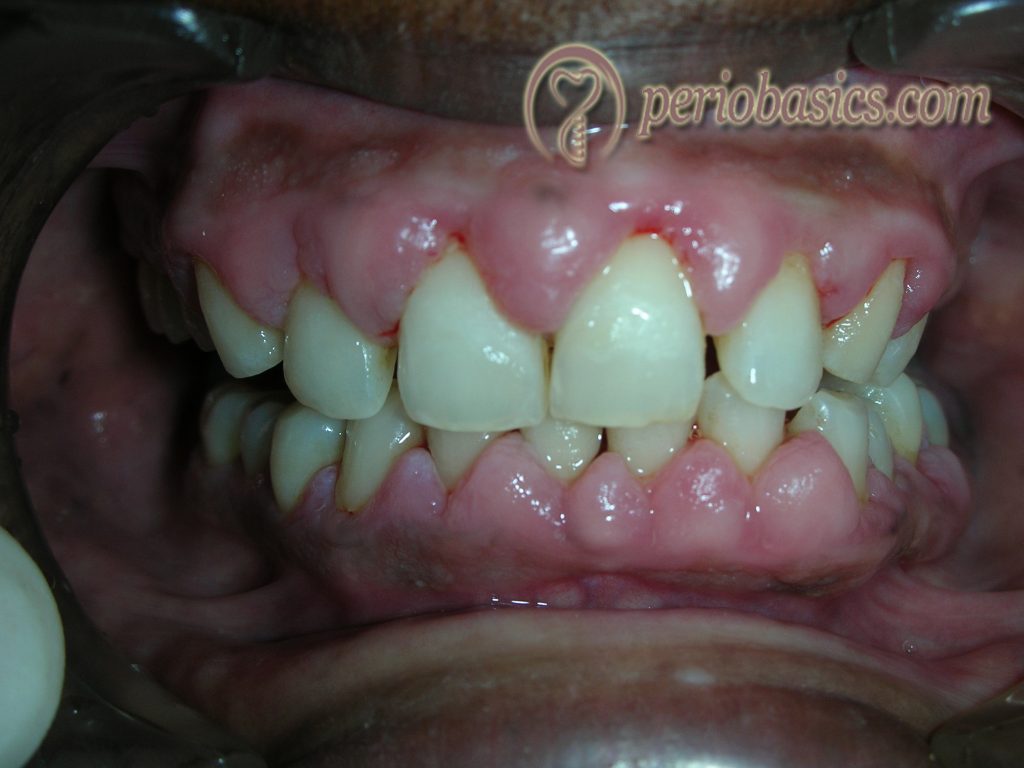 Valproic acid induced gingival enlargement