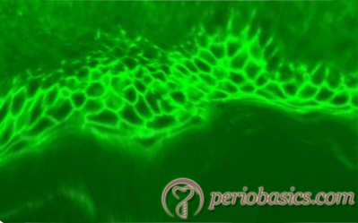 Direct immunofluorescence in pemphigus vulgaris