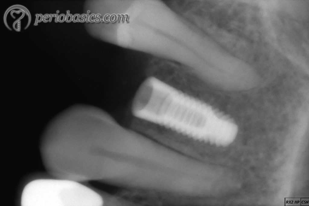 Radiograph after implant placement