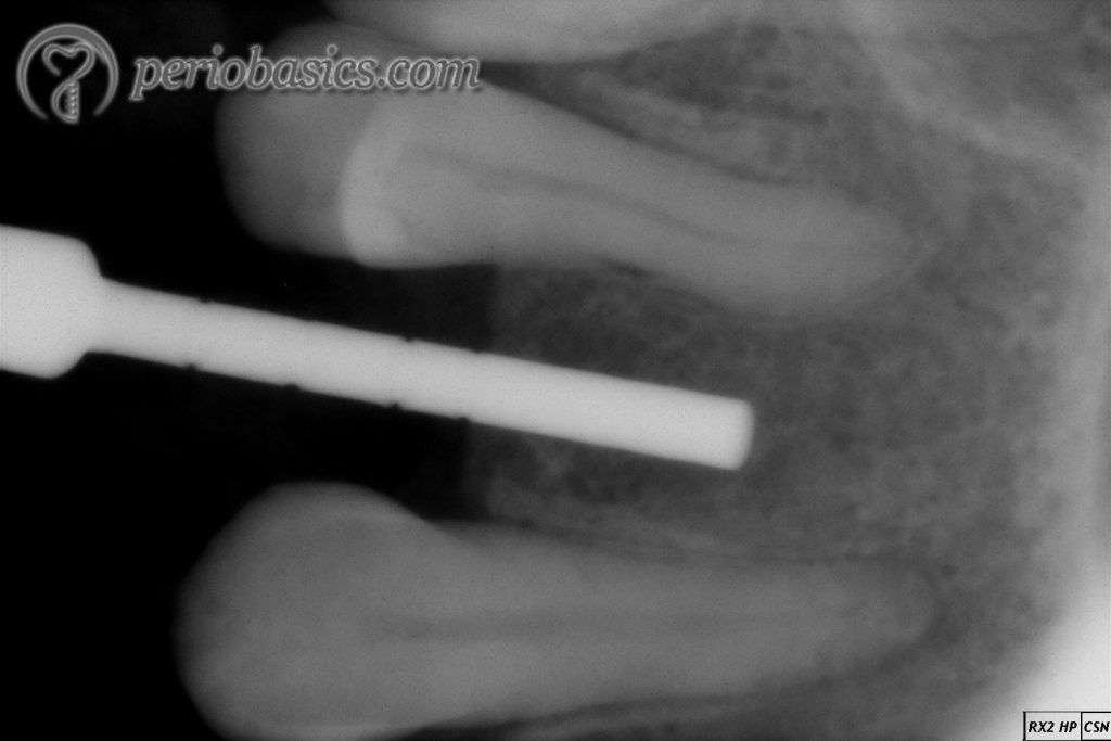 Radiograph after paralleling pin placement