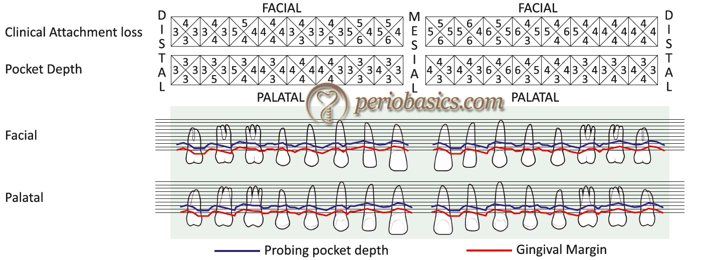 A sample chart for recording periodontal pocket depth and attachment loss