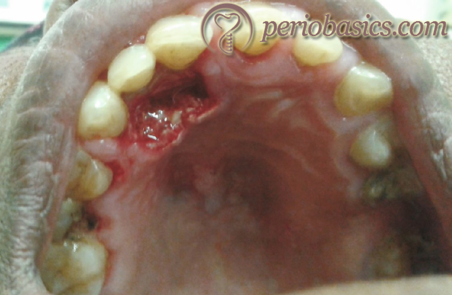 Acute necrotizing ulcerative gingivitis on the palatal aspect of maxillary right central and lateral incisor