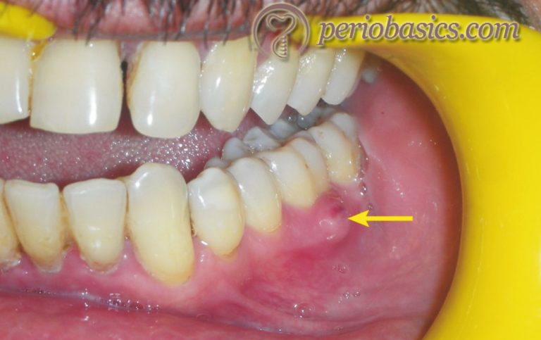 Periodontal abscess and its treatment – periobasics.com