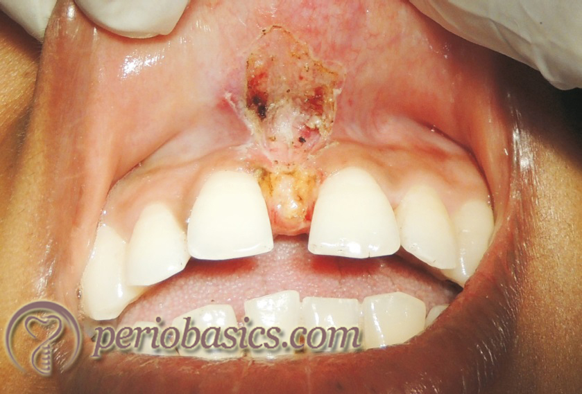 After frenectomy with laser application