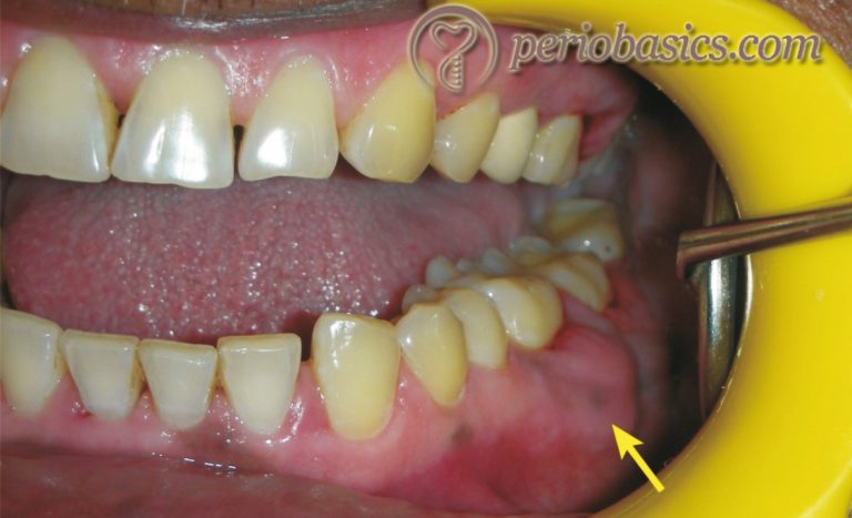 Periodontal Abscess And Its Treatment