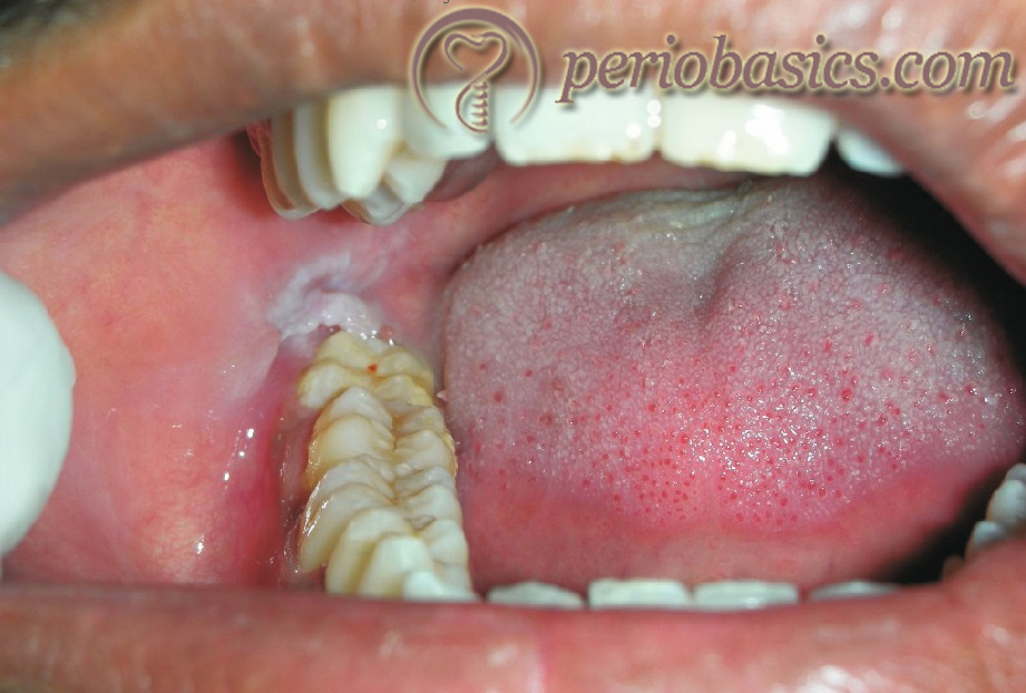 Clinical photograph of a chronic recurrent pericoronitis