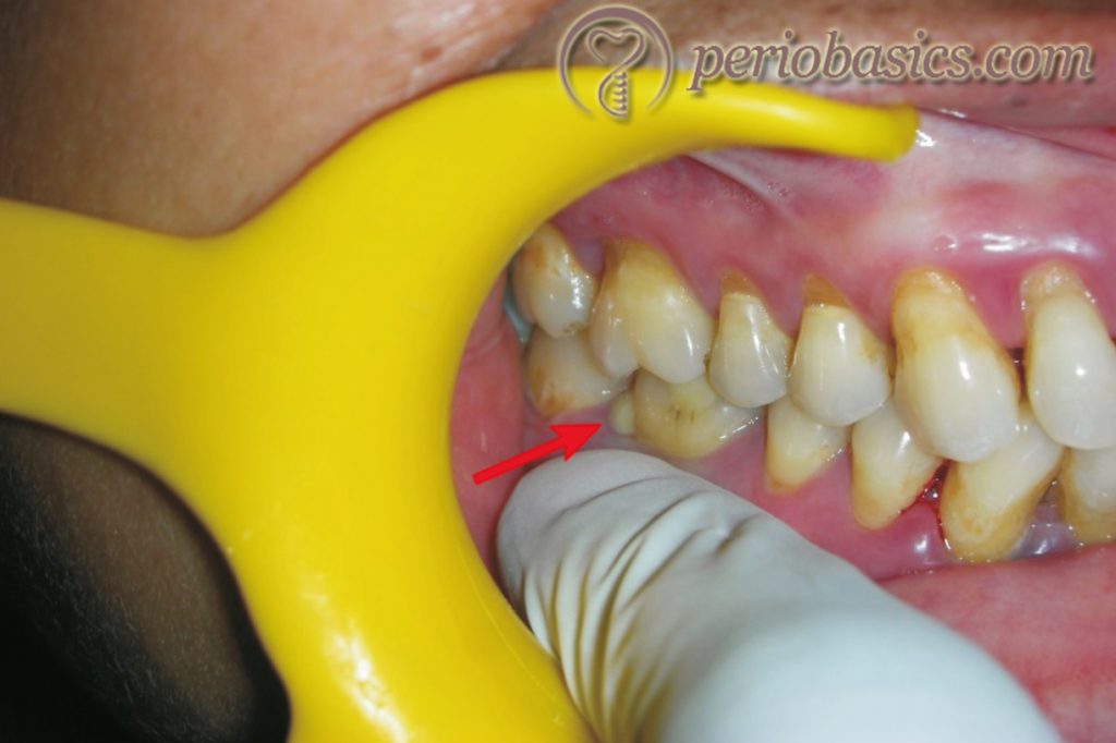 Clinical photograph of a patient with periodontal abscess.