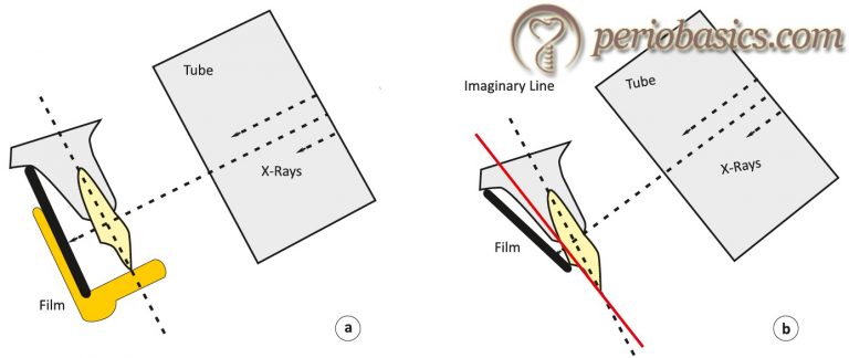 Radiographs In The Diagnosis Of Periodontal Diseases - Periobasics.com