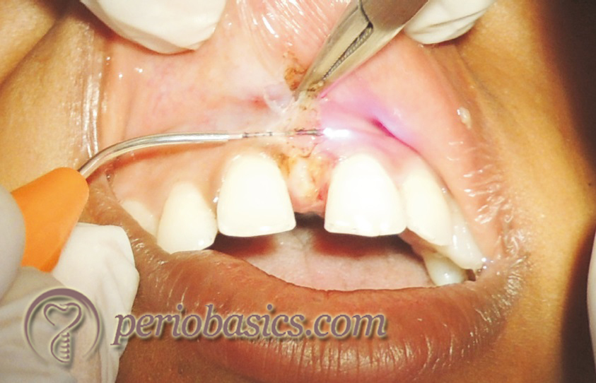 Frenectomy with laser application