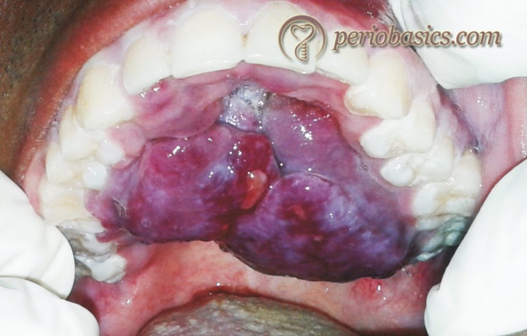 Fully developed Kaposi's sarcoma on palate of a HIV-positive patient