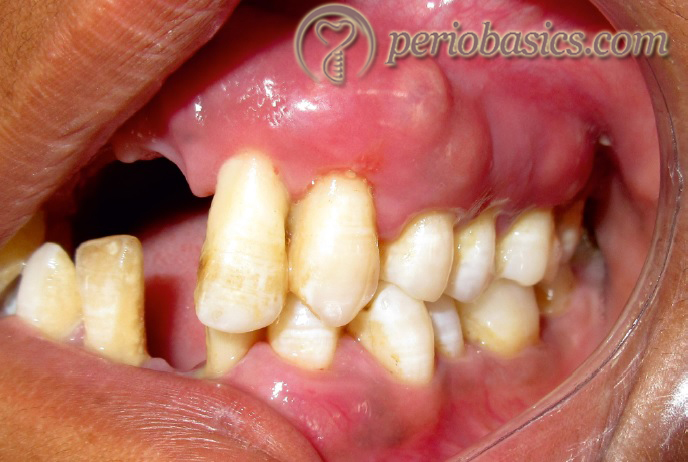 Multiple periodontal abscesses in an uncontrolled diabetic patient.