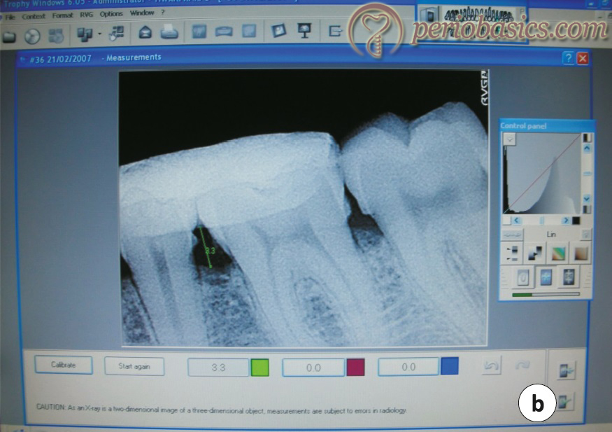 RVG image with radiopaque stent