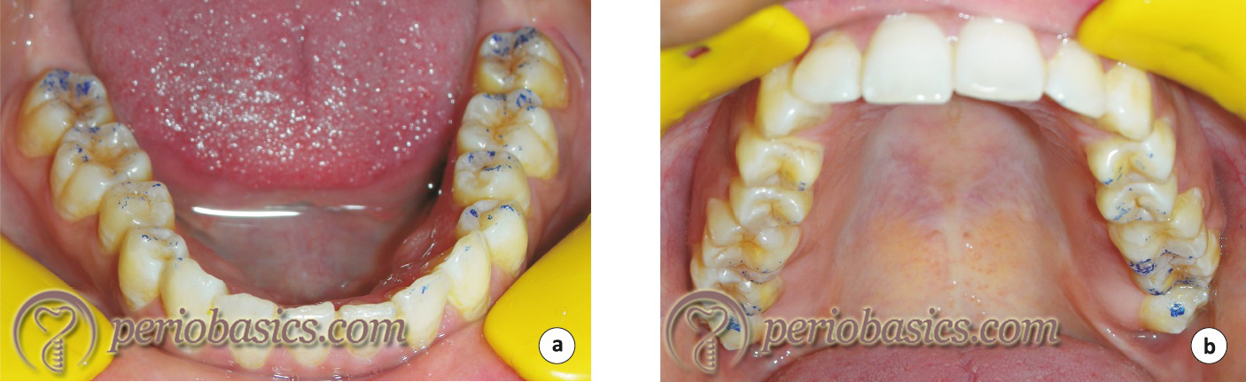 Recording of occlusal interferences in centric relation to centric occlusion position.