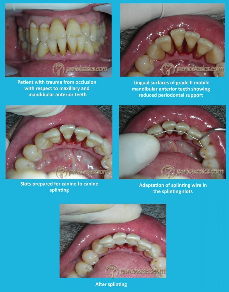 Trauma from occlusion