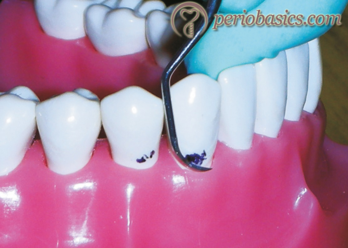 Principles of scaling and root planing