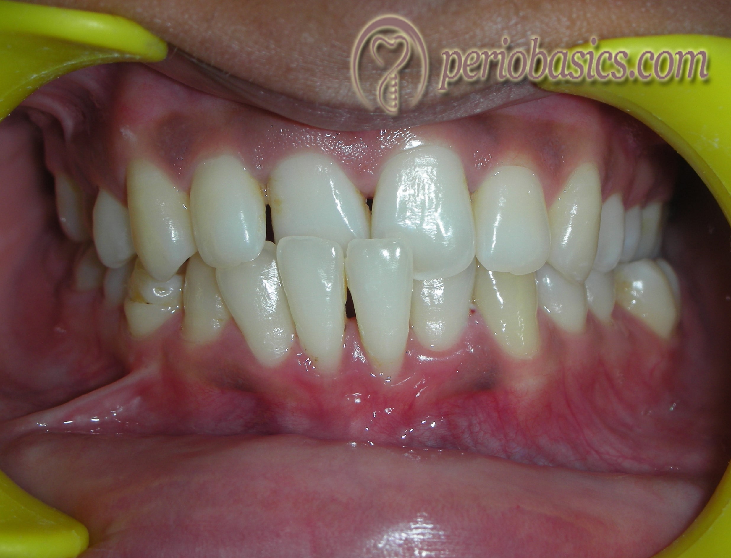 Trauma from occlusion caused in lower and upper central incisors due to cross bite.