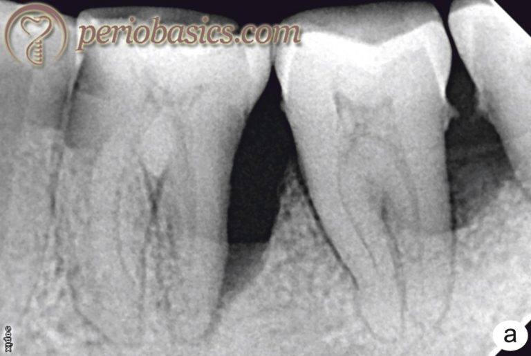 Periodonticendodontic interrelationship