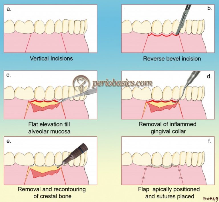 History of surgical periodontal pocket therapy and osseous resective ...