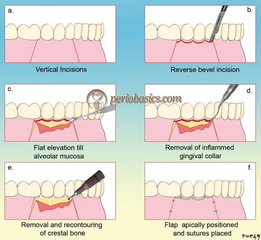 History of surgical periodontal pocket therapy and osseous resective  surgeries – 