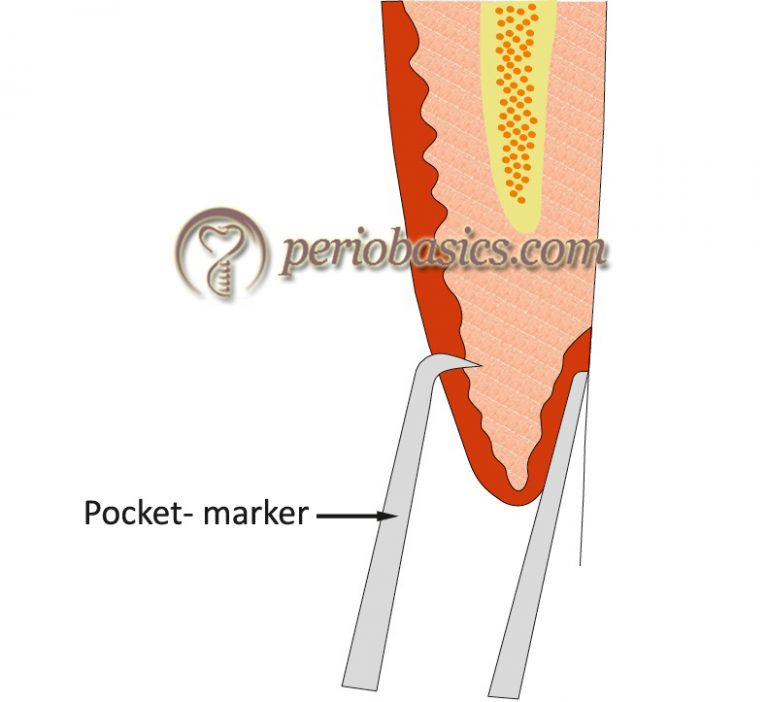 Gingivectomy and Gingivoplasty