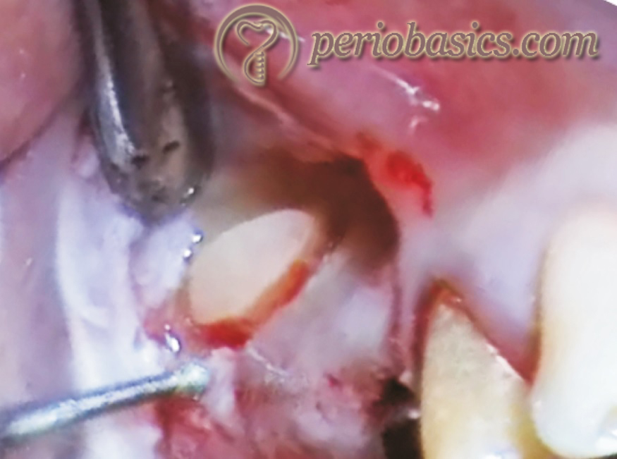 Application of piezosurgery for sinus lift procedure.