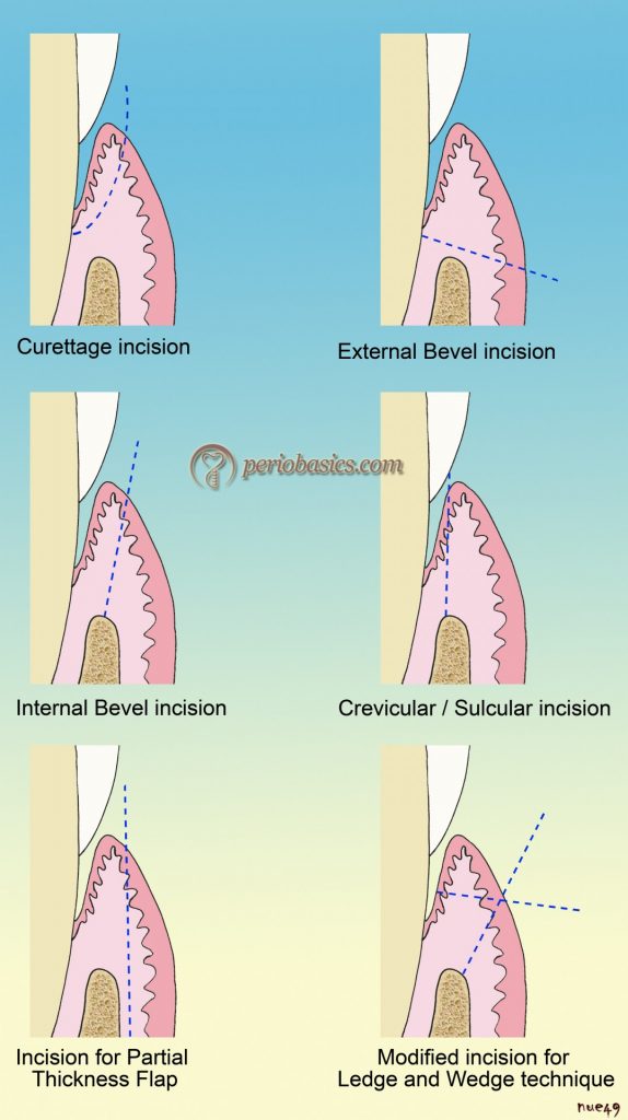 Basic incisions used in periodontal surgeries