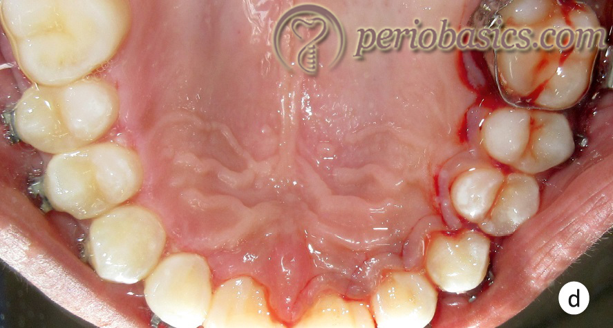 Gingivectomy case d